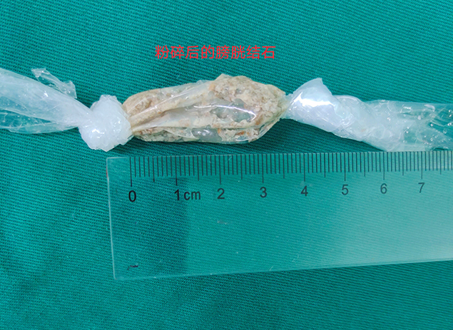 又一百岁老人成功治愈！济医附院兖州院区泌尿外科微创手术巧治膀胱结石2.jpg