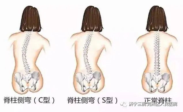 关注青少年脊柱健康！寒假期间康复治疗八折优惠不容错过！1.jpg
