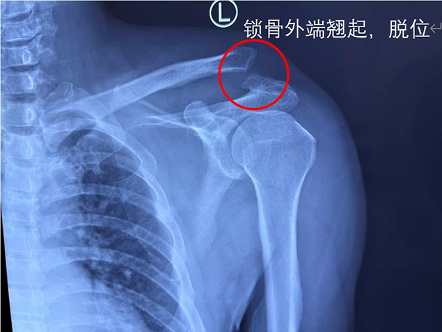 创伤骨科成功实施陈旧性肩锁关节脱位修复术2.jpg