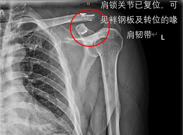 创伤骨科成功实施陈旧性肩锁关节脱位修复术3.jpg