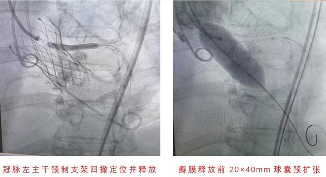 心脏介入新突破｜心血管内科微创介入团队成功完成主动脉瓣膜植入术3.jpg